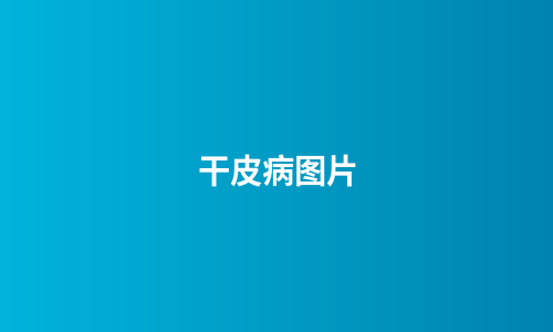 干皮病图片
