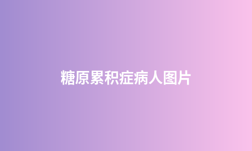 糖原累积症病人图片