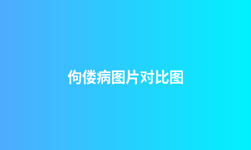 佝偻病图片对比图